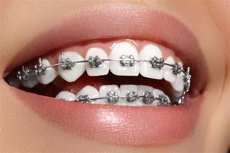 tipos de brackets metalicos y precios|brackets convencionales.